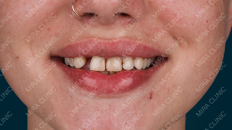 Hollywood smile Before & after